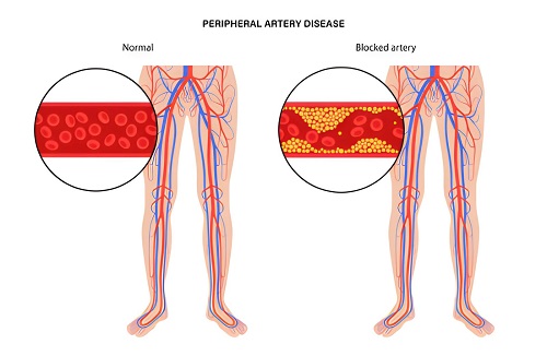 Best Doctor for Blocked Leg Arteries in Andheri, Mumbai